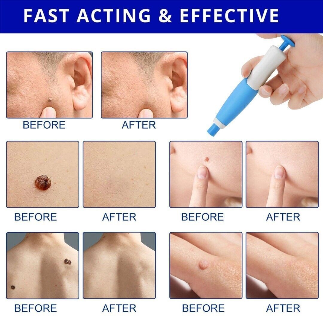 2in1 Wart Papilloma Skin Tag Remover Painless Remover Wart Remover Kit