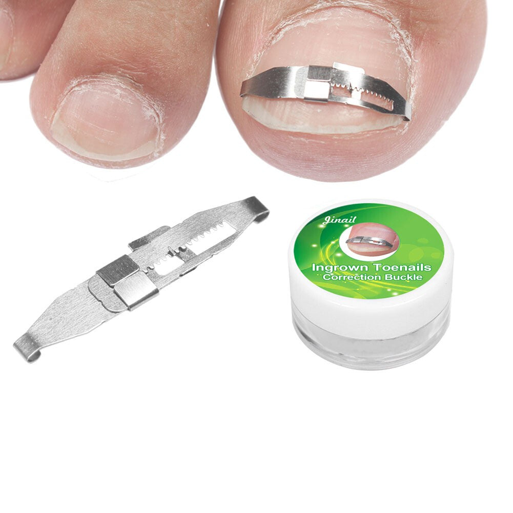 2×Ingrown Fixer Wire Toenail Correction Nail Ingrowing Corrector Pedicure
