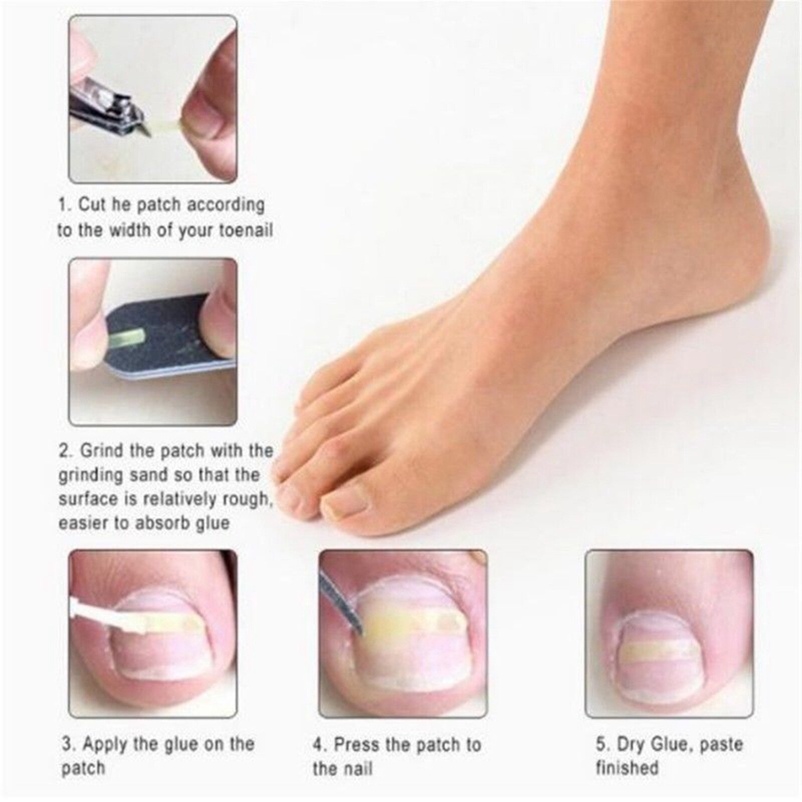 Ingrown Nail Straightening Clip Brace Elastic Toe Nail Treatment
