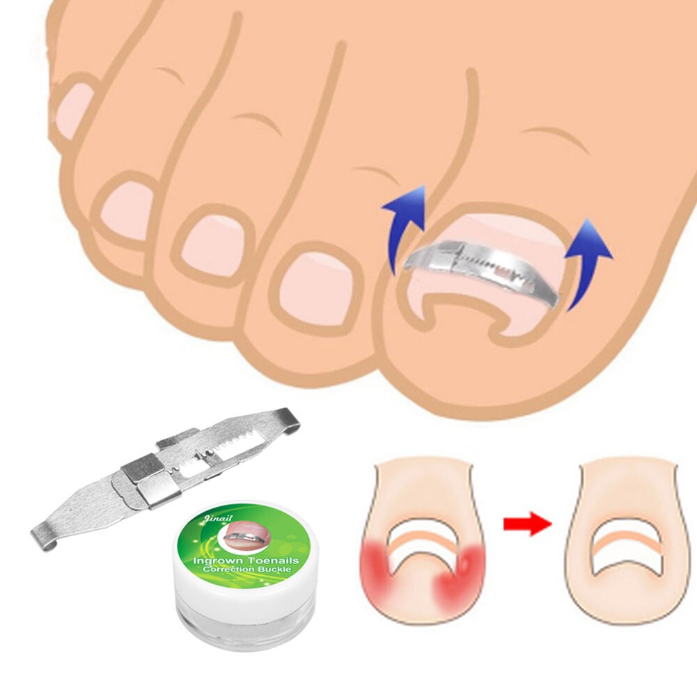 2×Ingrown Fixer Wire Toenail Correction Nail Ingrowing Corrector Pedicure