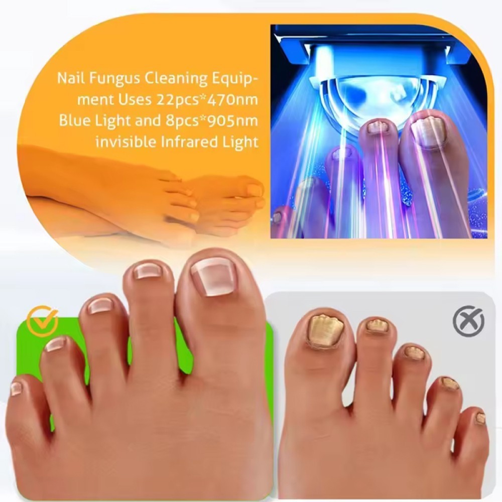 Nail Fungus Laser Device Light Therapy Onychomycosis Toes Treatment Anti Fungal