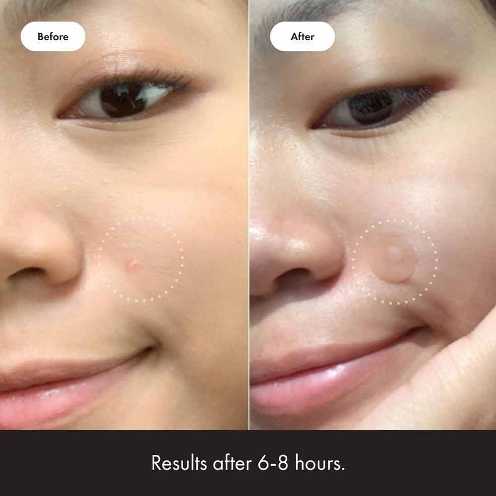 72X Mighty Patch Acne Patches Spot Acne Treatment Hydrocolloid Dot Skin Care