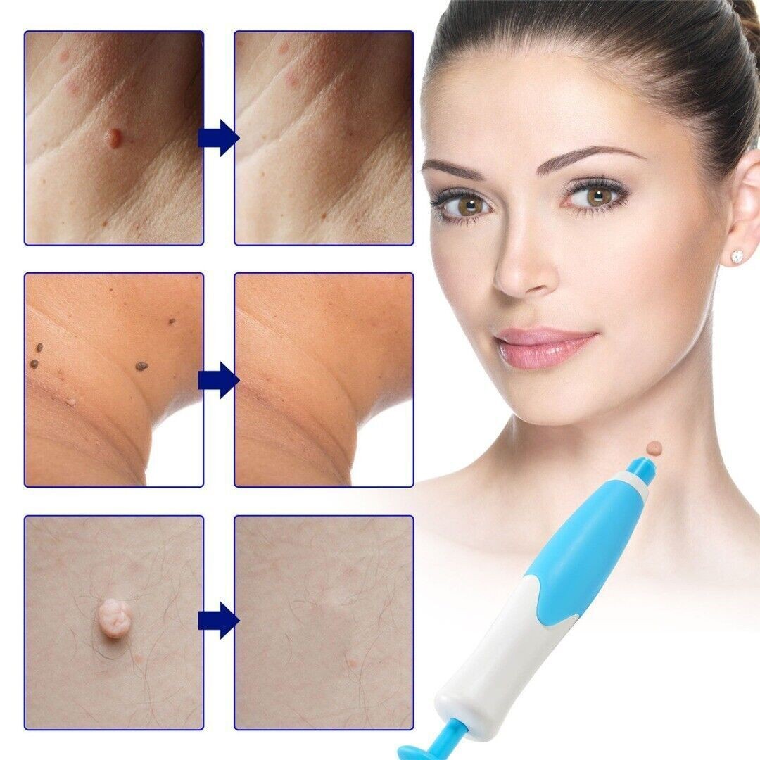 2in1 Wart Papilloma Skin Tag Remover Painless Remover Wart Remover Kit