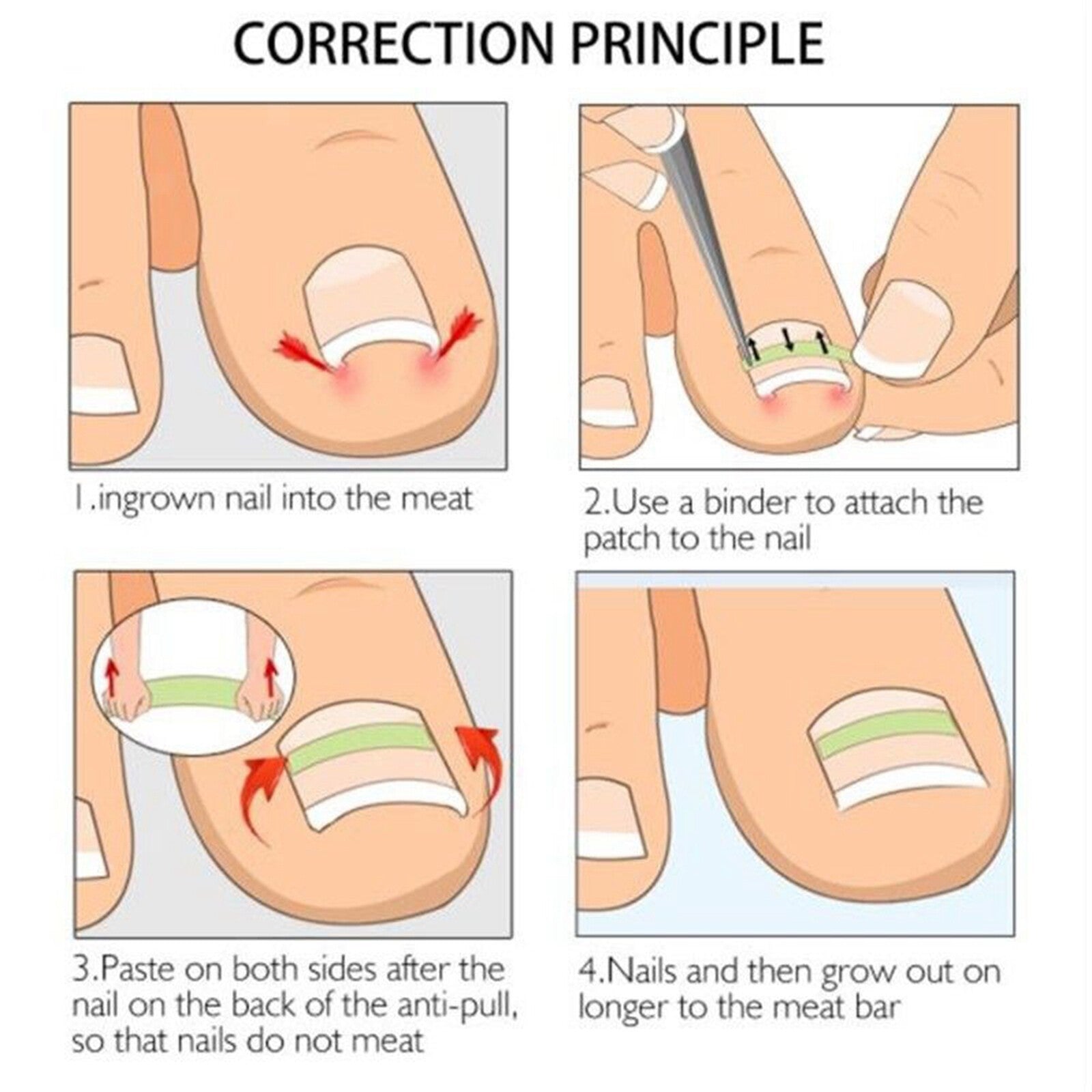 Ingrown Nail Straightening Clip Brace Elastic Toe Nail Treatment