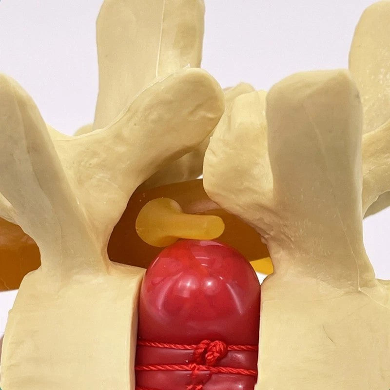 Lumbar Model Human Anatomy Skeleton Spine Lumbar Disc Herniation Teaching Model