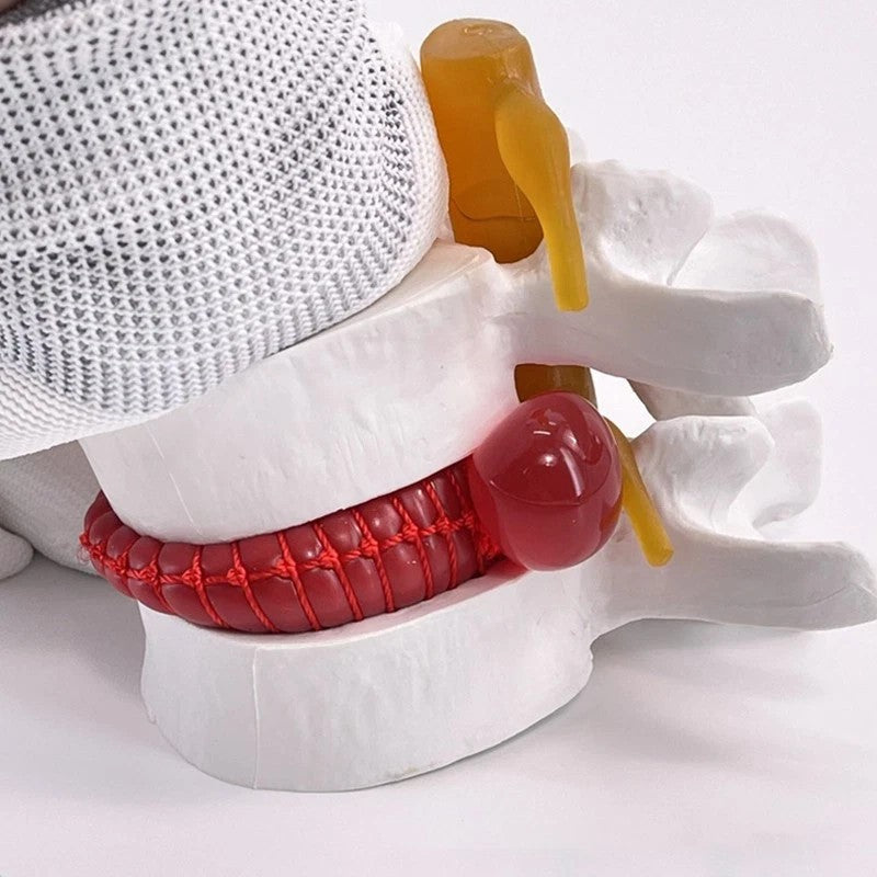 Lumbar Model Human Anatomy Skeleton Spine Lumbar Disc Herniation Teaching Model