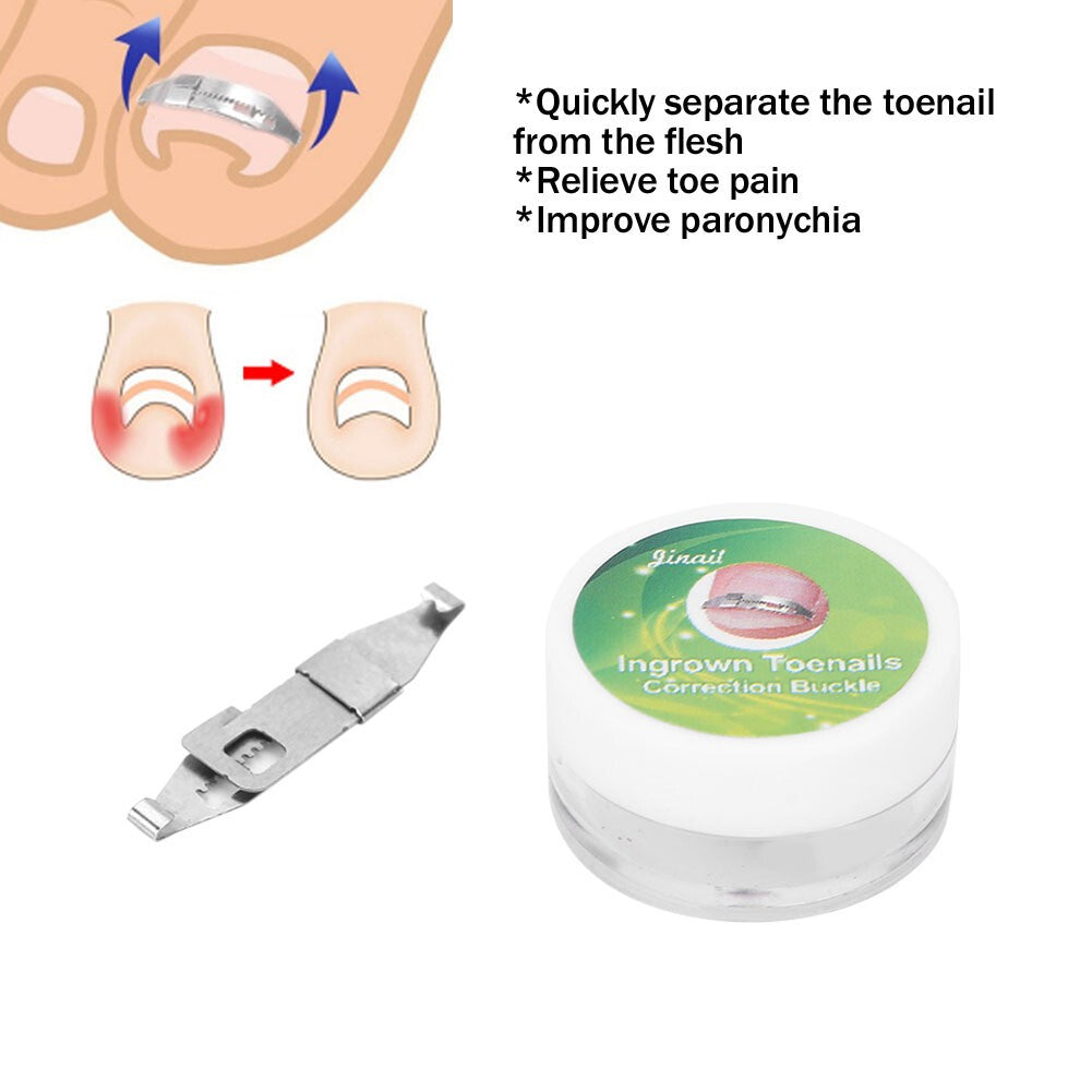 2×Ingrown Fixer Wire Toenail Correction Nail Ingrowing Corrector Pedicure