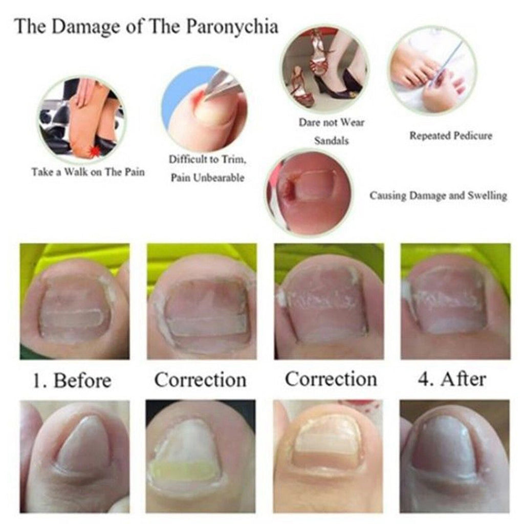 Ingrown Nail Straightening Clip Brace Elastic Toe Nail Treatment