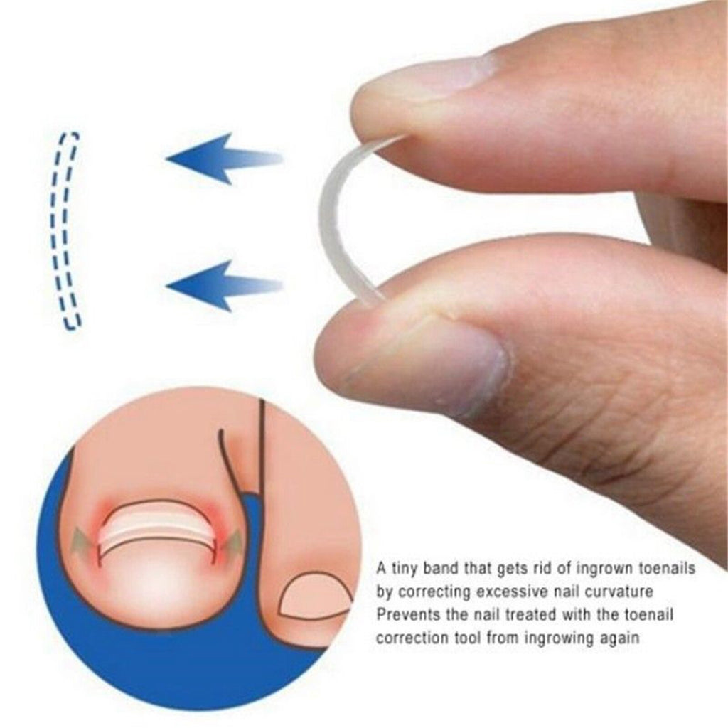 Ingrown Nail Straightening Clip Brace Elastic Toe Nail Treatment