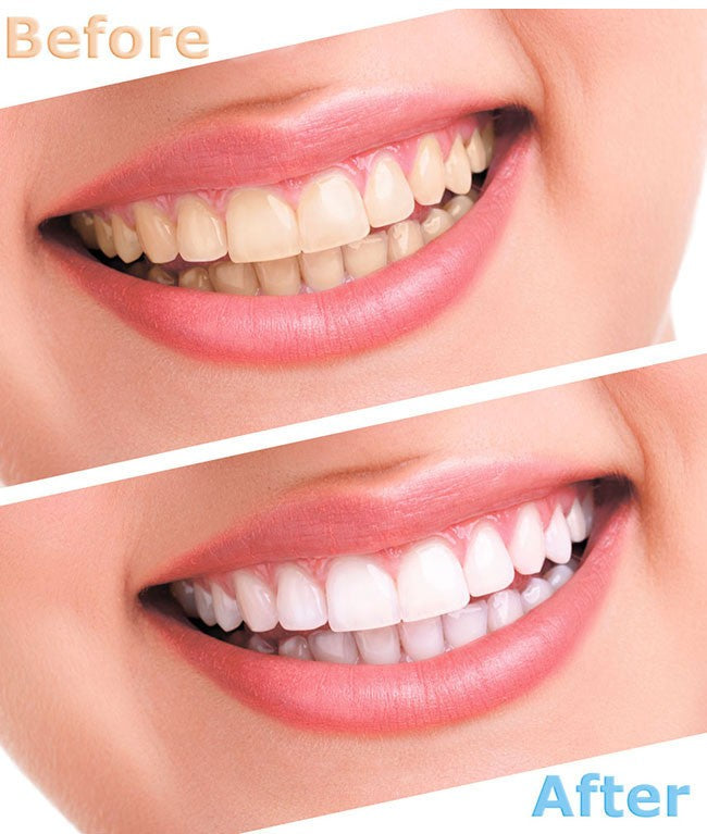 LED Teeth Whitening Light Blue Light Tooth Bleaching Lamp Home Dental Kit