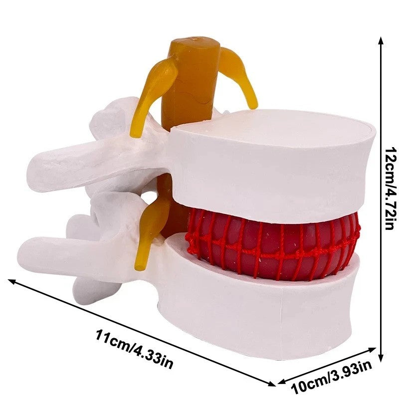 Lumbar Model Human Anatomy Skeleton Spine Lumbar Disc Herniation Teaching Model