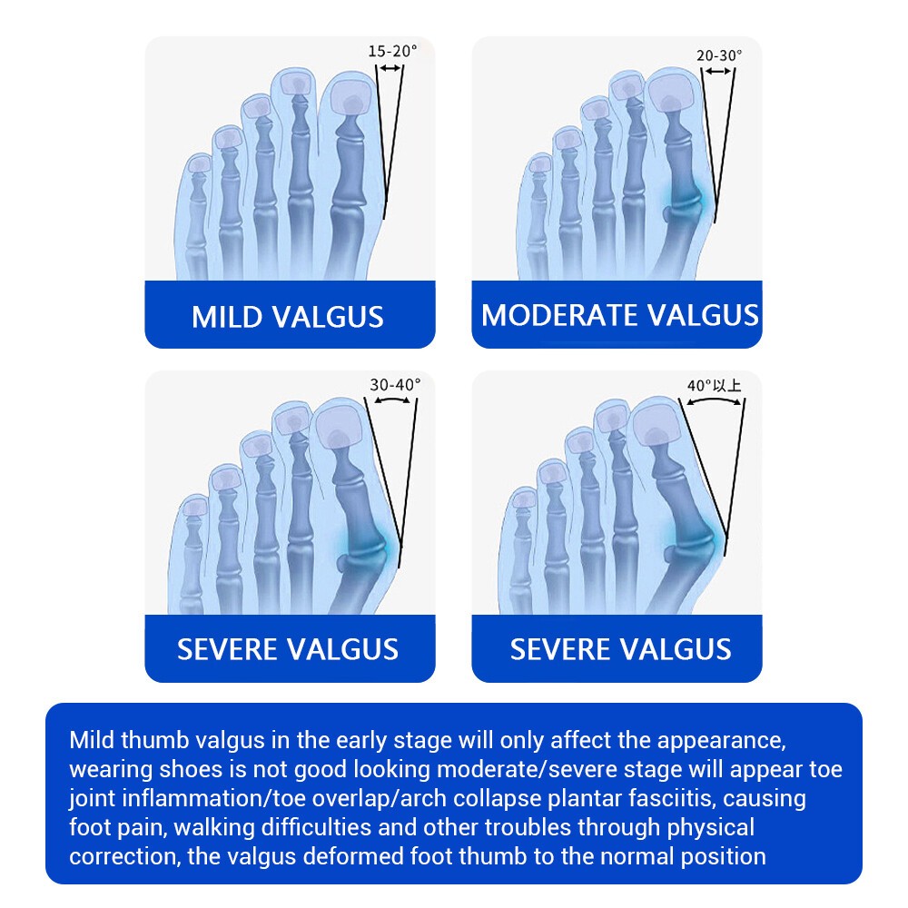 Orthopedic Toe Bunion Corrector Straightener Splint Support Flexible Strap