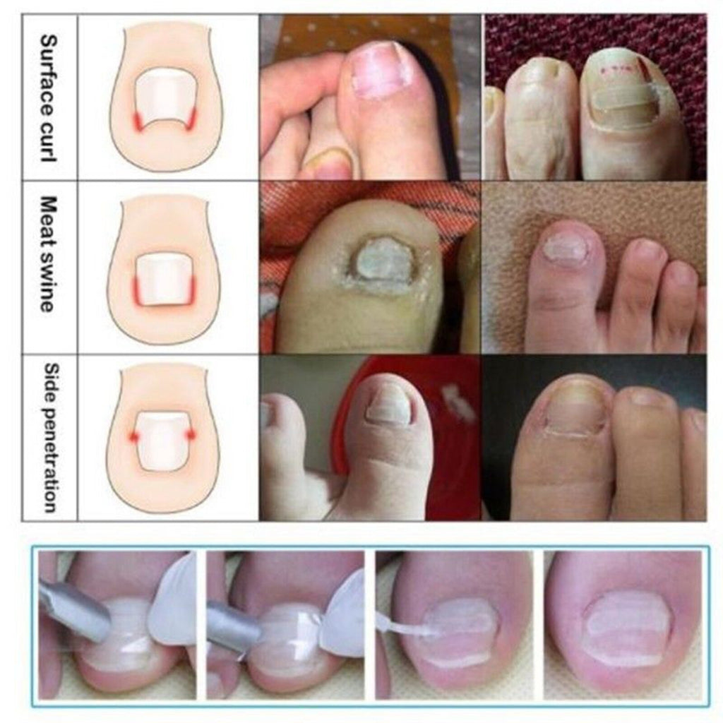 Ingrown Nail Straightening Clip Brace Elastic Toe Nail Treatment