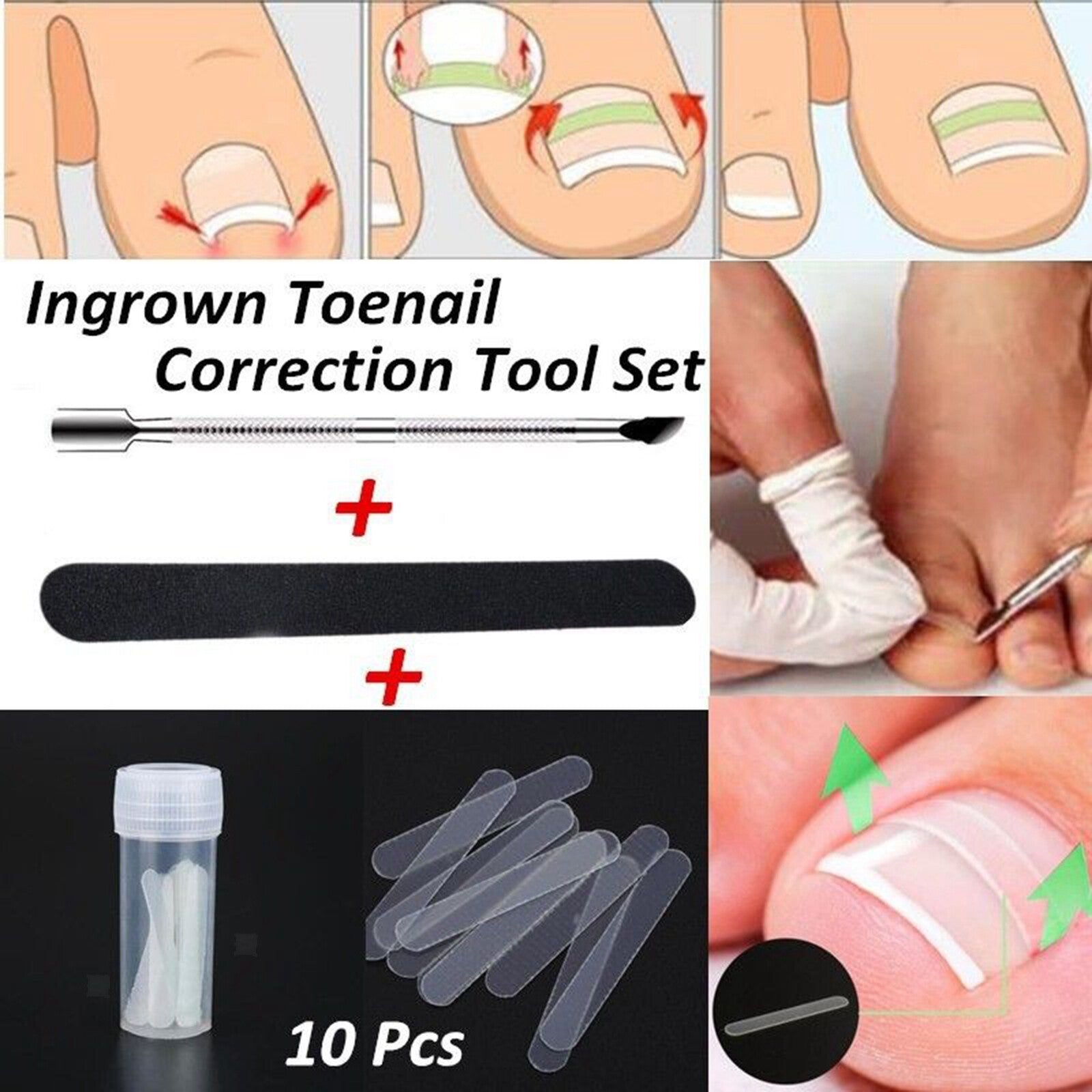 Ingrown Nail Straightening Clip Brace Elastic Toe Nail Treatment