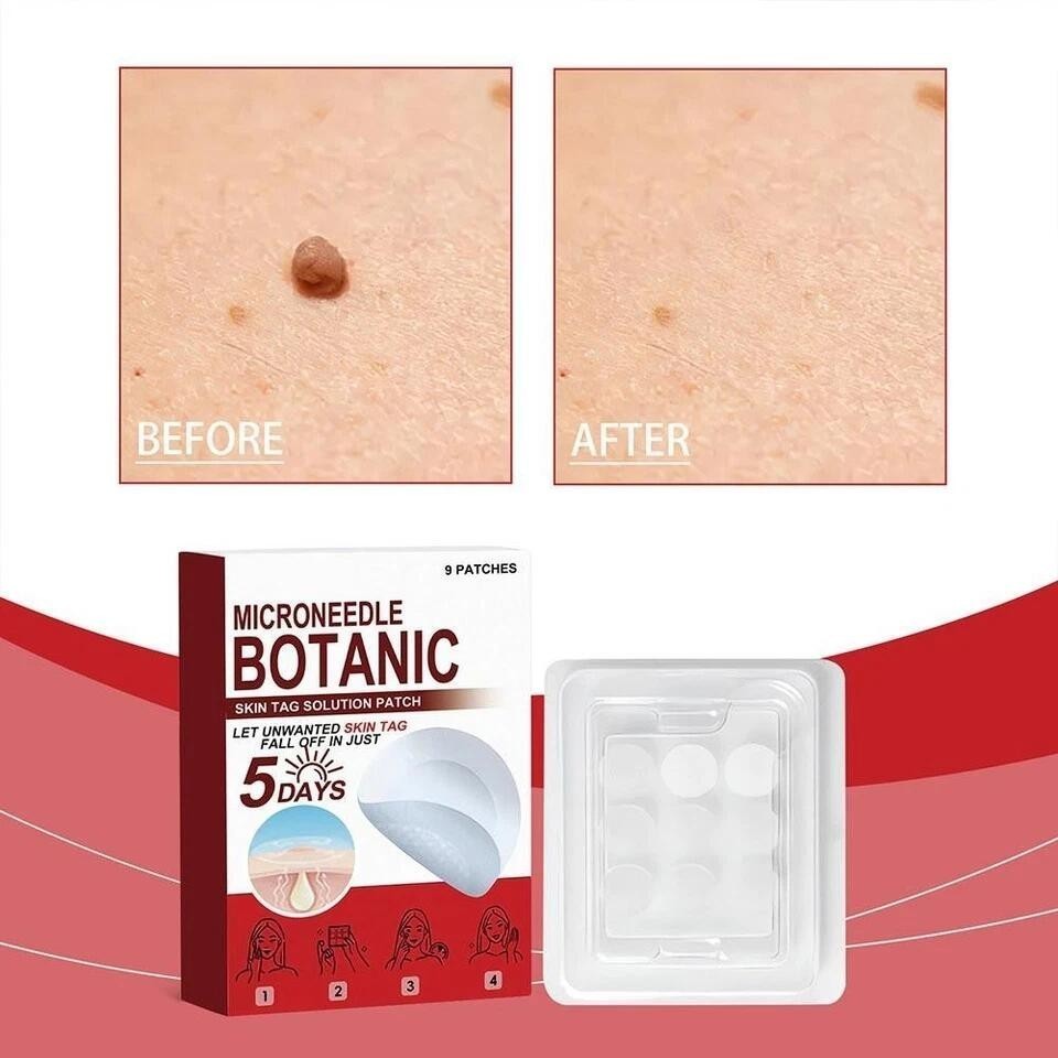 BOX MICRONEEDLE BOTANIC Skin Tag & Acne Patch 9 Pcs Skin Tag Remover Patches