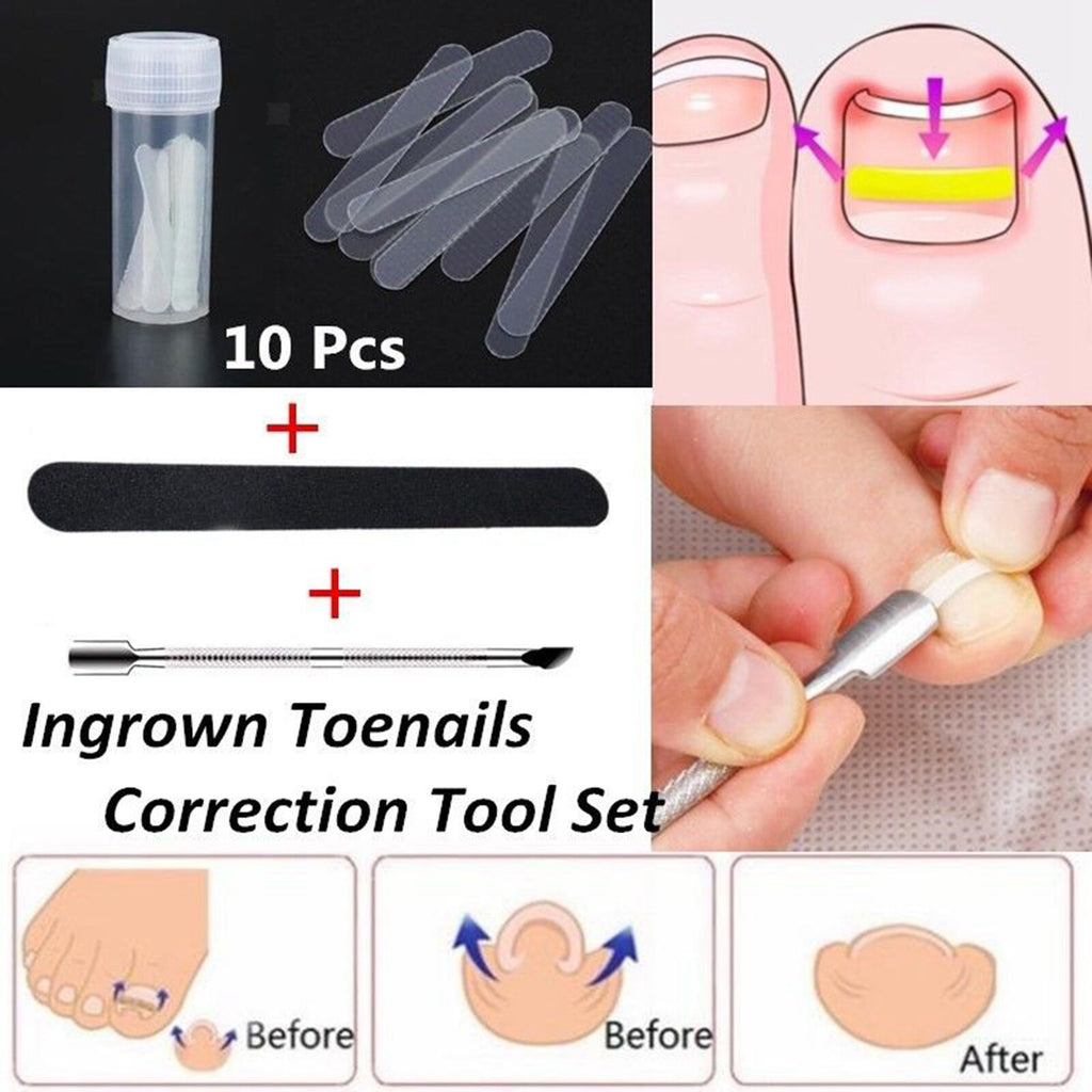 Ingrown Nail Straightening Clip Brace Elastic Toe Nail Treatment