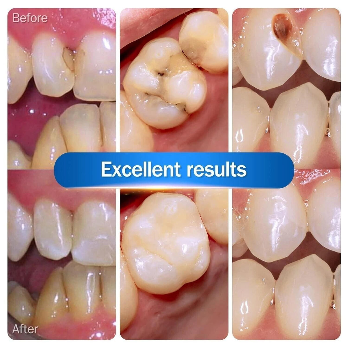 New Dental Cement Cavity Filling Strong Teeth Tooth Repair Restoration Filling